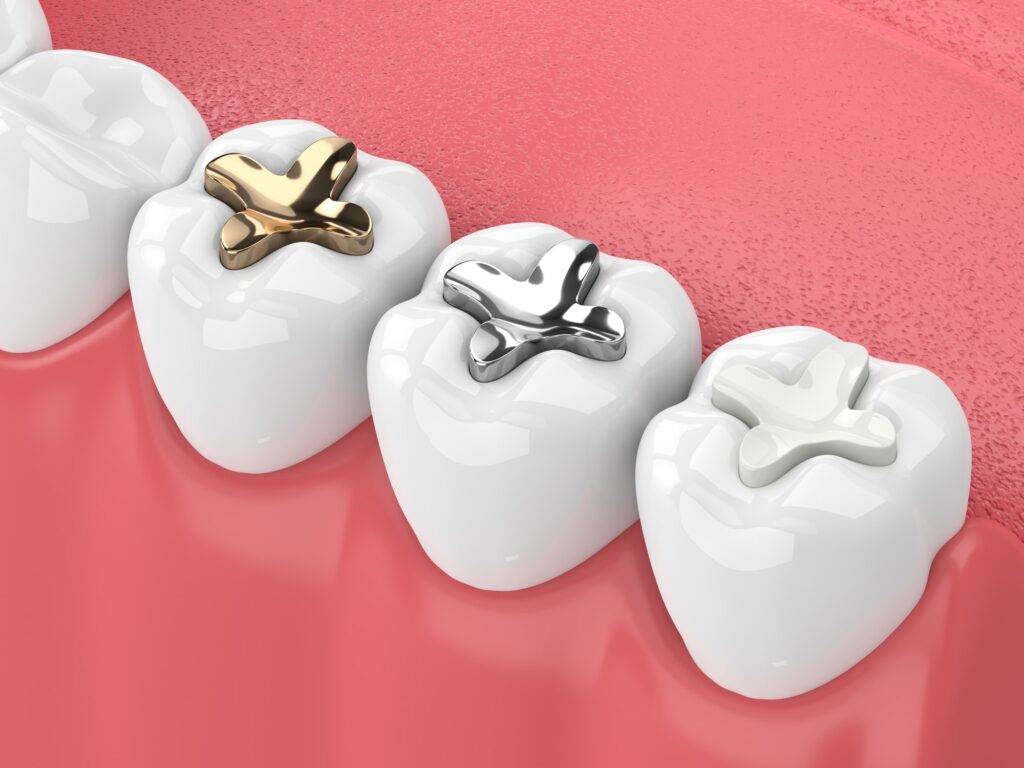 Tooth Fillings and Sealants