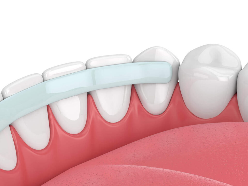 dental bonding dental service