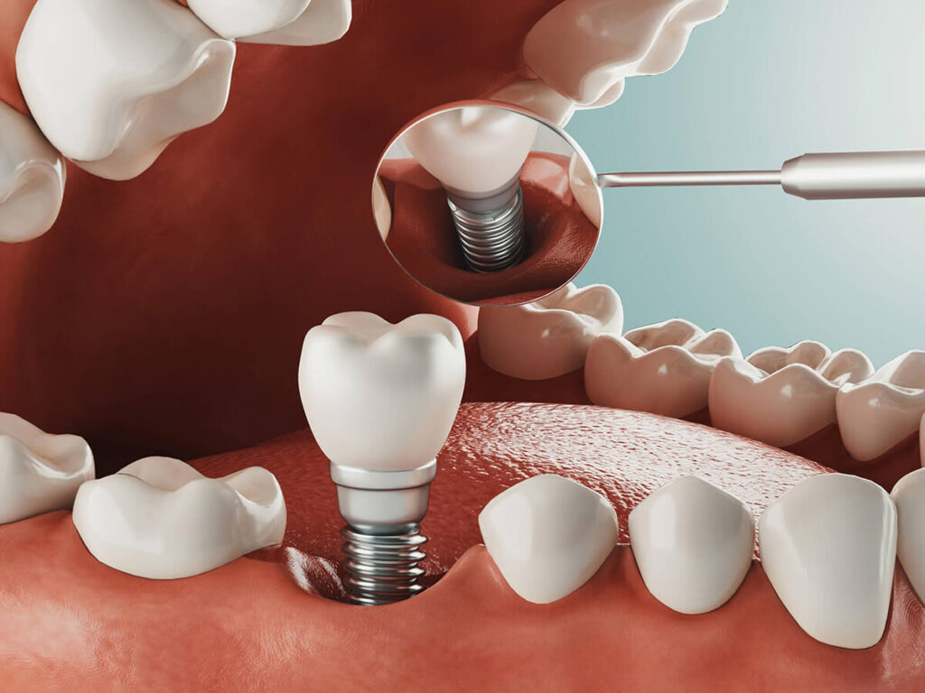 Dental Implants service