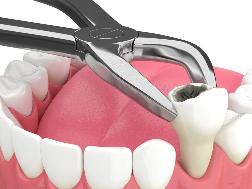 Tooth Extractions Dental Service