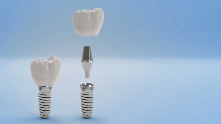 all on four dental implants
